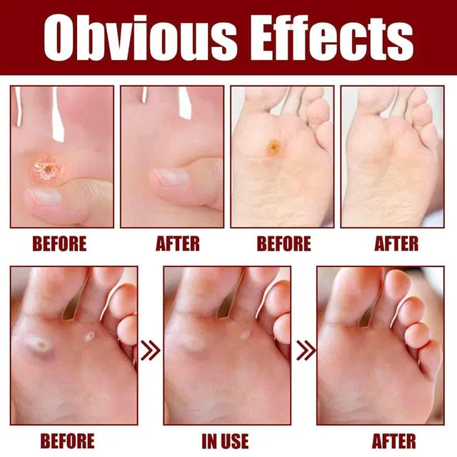 Feet Corn Removal Serum 30ml – Foot Care Serum, Pack of 1